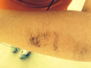 Day 329 | Fell while running today. Scraped my arm up pretty… | Flickr