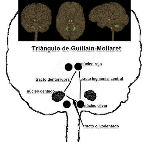 Triángulo de Guillain-Mollaret