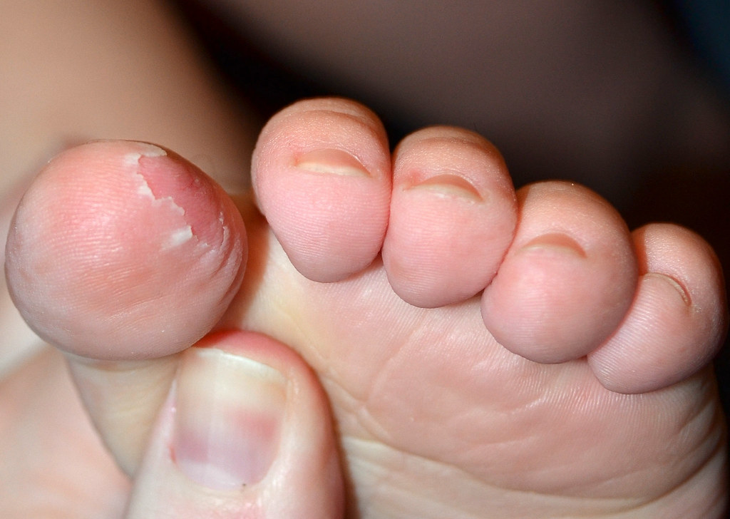 Dry Peeling Skin On Toddlers Toes