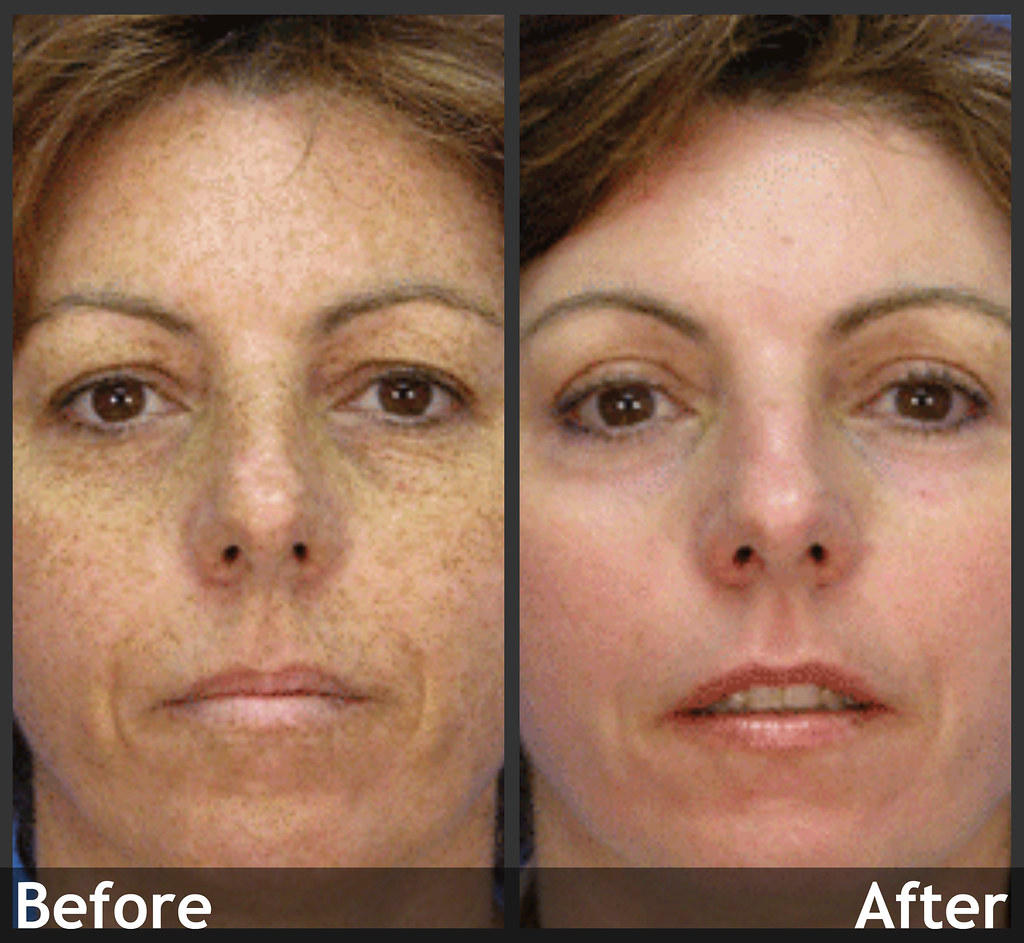 IPL Laser Treatment Before &amp; After: Sun Damage Removal 