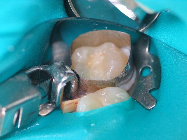color stability of dental composite resin tooth