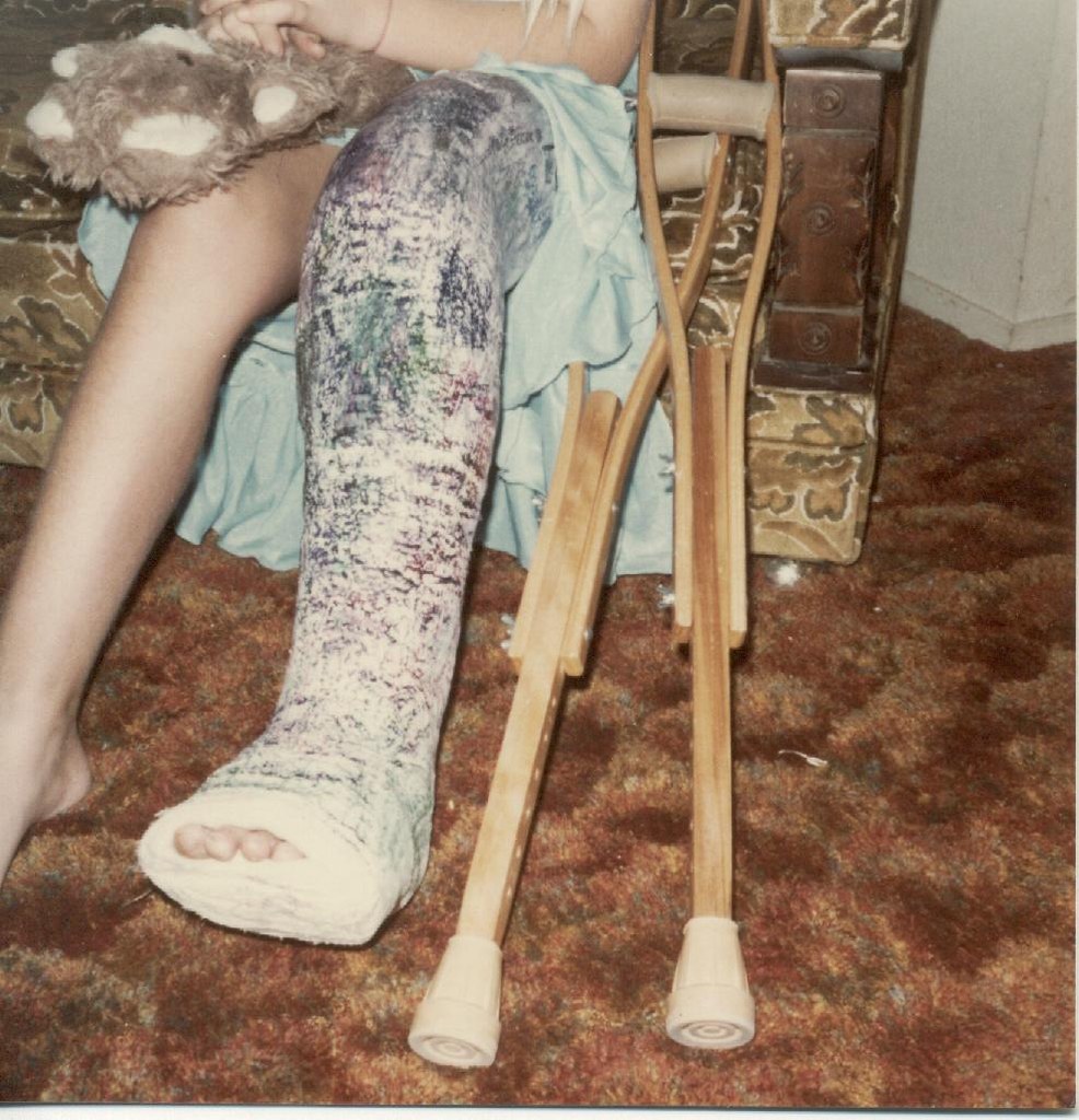 my-broken-leg-week-before-halloween-when-i-was-8-yrs-old-nccmrm97