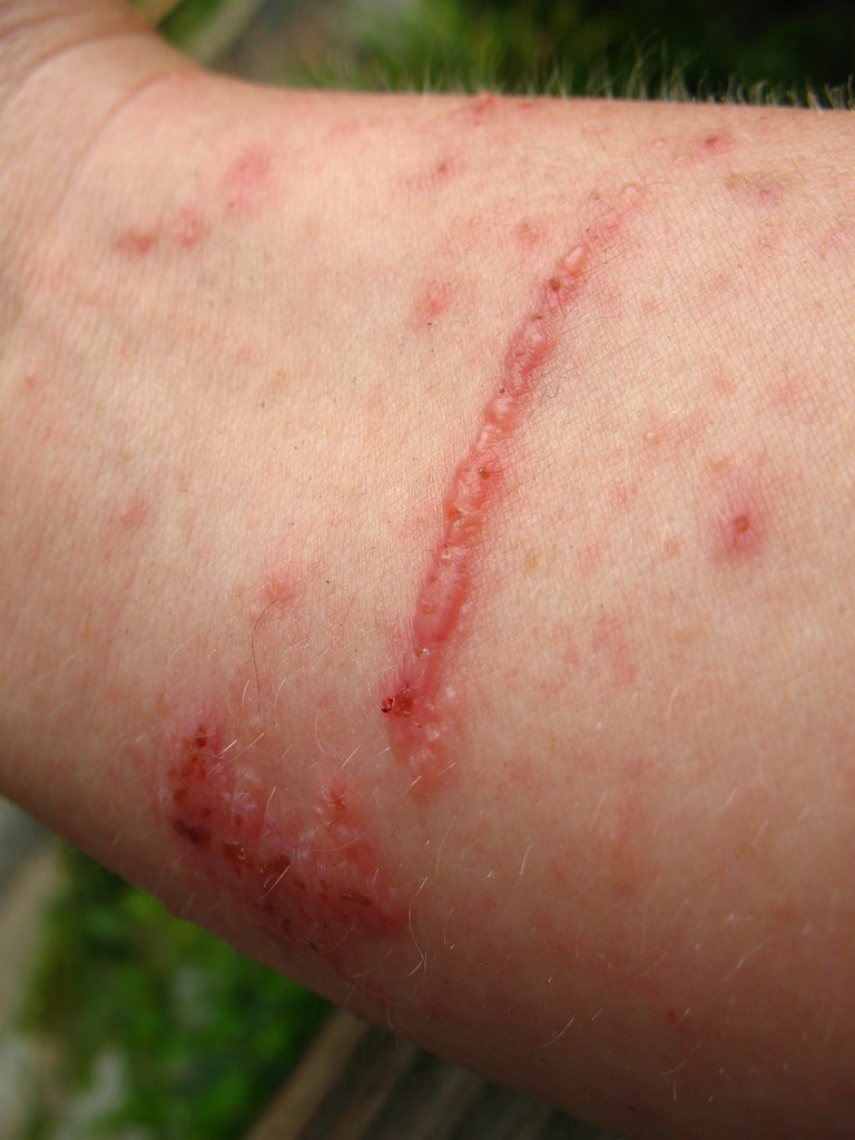 poison ivy on arm
