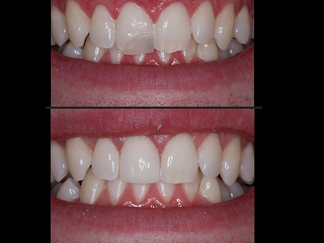 color stability of dental composite resin