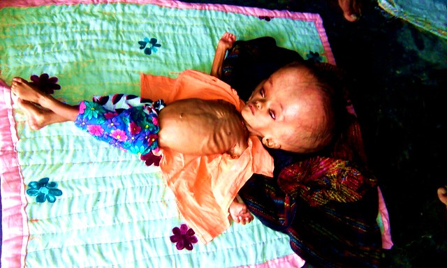 malnutrition Falak in Varanasi