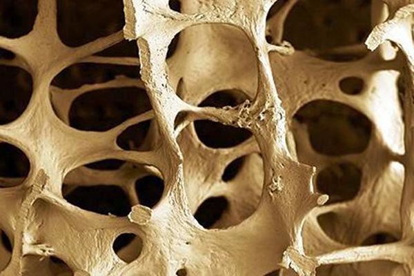 La Osteoporosis afecta a hombres y mujeres http://t.co/O38Vnv6jYz