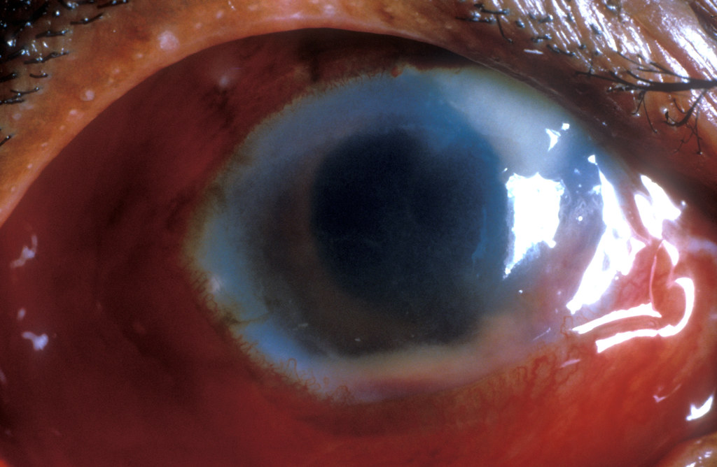 post-operative-endophthalmitis-following-cataract-surgery-flickr