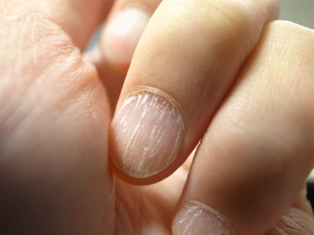 Brittle Nails Point To Thyroid Drawback