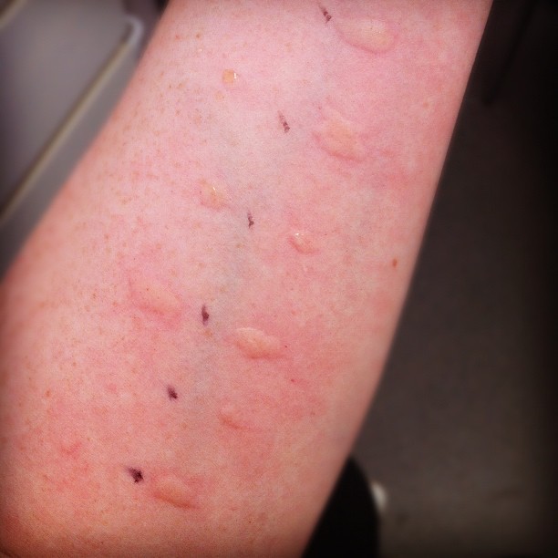 Allergy Testing Im Getting Some Pretty Amazing Welts Thi Flickr