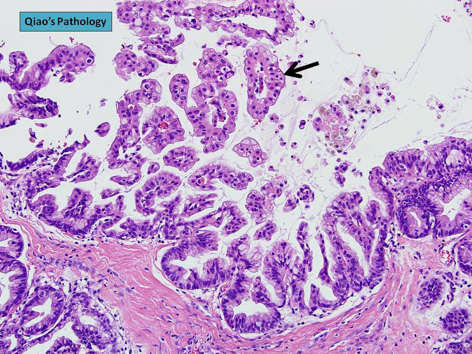 Qiao's Pathology: Mucinous Cystadenocarcinoma of Ovary | Flickr