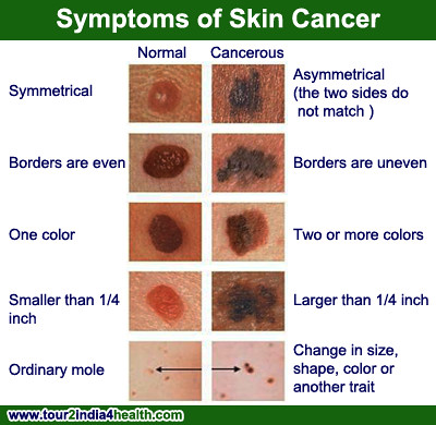 What are the symptoms of skin cancer?