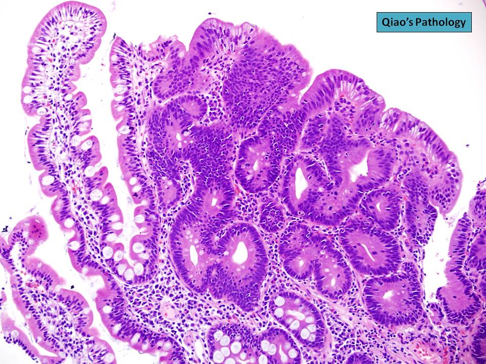 Pathology Outlines - Tubulovillous adenoma