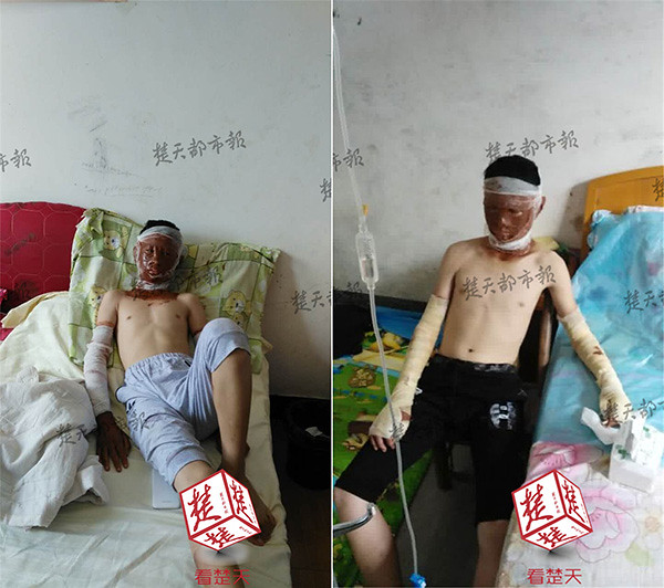 Hubei youth rain picked up the balloon, use hair dryer to blow dry result was wounded