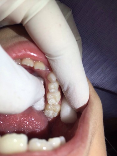 【推薦】讓妹妹不害怕的兒童牙科珍所，到高雄西河牙醫診所做第一大臼齒窩溝封填(溝隙封填)_第6步：完成2，窩溝封填都是白色的