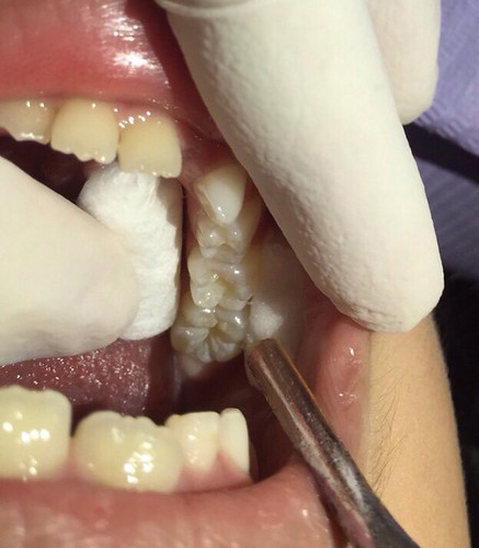 【推薦】讓妹妹不害怕的兒童牙科珍所，到高雄西河牙醫診所做第一大臼齒窩溝封填(溝隙封填)_第3步_完全吹乾的牙齒，色澤偏粉筆白，縫隙超明顯