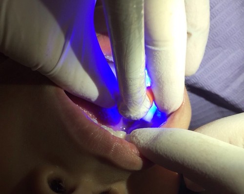 【推薦】讓妹妹不害怕的兒童牙科珍所，到高雄西河牙醫診所做第一大臼齒窩溝封填(溝隙封填)_第5步：照固態光