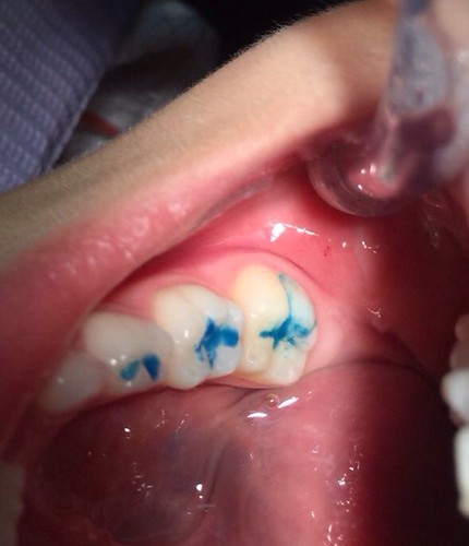 【推薦】讓妹妹不害怕的兒童牙科珍所，到高雄西河牙醫診所做第一大臼齒窩溝封填(溝隙封填)_第2步-清潔：塗抹層除去、酸蝕過程