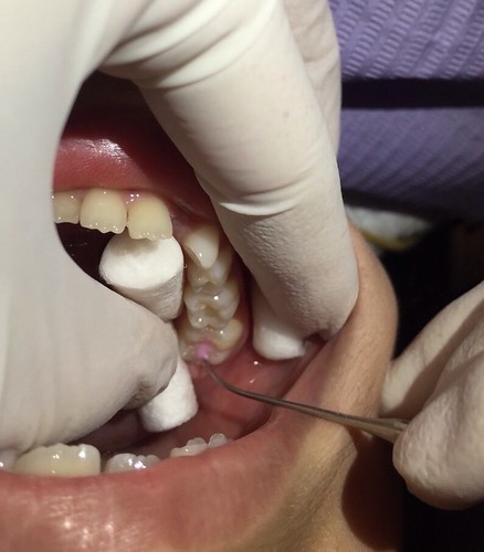 【推薦】讓妹妹不害怕的兒童牙科珍所，到高雄西河牙醫診所做第一大臼齒窩溝封填(溝隙封填)_第4步_窩溝封填2